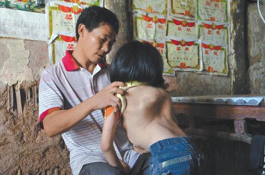 有嚴(yán)重脊椎畸形及胸腔隆突病的李文霞。