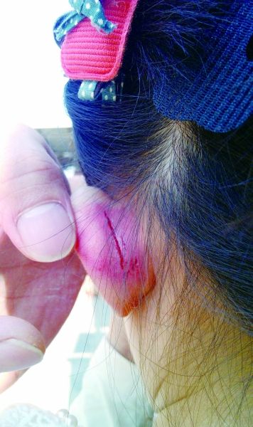 　　女童的耳朵被老師揪裂。圖片由女童家人提供