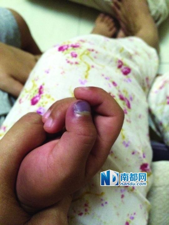 小逸手指被夾傷。