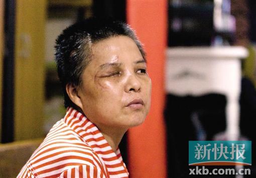 4月初,趙女士遭人搶劫并被打傷,現(xiàn)今右眼失明,頭部被縫100多針。記者 畢志毅/攝