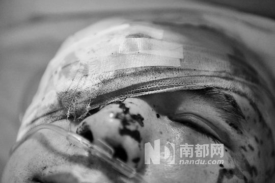 李建新頭部還有被潑硫酸的痕跡，醫(yī)生說被砍傷的右眼已經(jīng)失明。 南都記者 田飛 攝