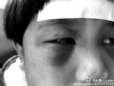 6月2日，網(wǎng)曝渭南市臨渭區(qū)一不滿5歲的女童遭奶奶毆打，眼圈青腫，引起網(wǎng)友關注，但孩子父母和爺爺均稱是摔倒導致。相關部門介入調(diào)查發(fā)現(xiàn)確為奶奶毆打所致，鑒于其身體原因已進行批評教育。