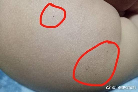 據(jù)多名紅黃藍(新天地分園)家長反映，孩子腿部、屁股、腋下出現(xiàn)針眼。