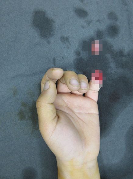 嚇哭！6歲男孩被夾斷手指 罪魁禍首竟是校服