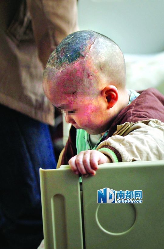 1月8日下午，小寶頭上和臉上都是傷痕。
