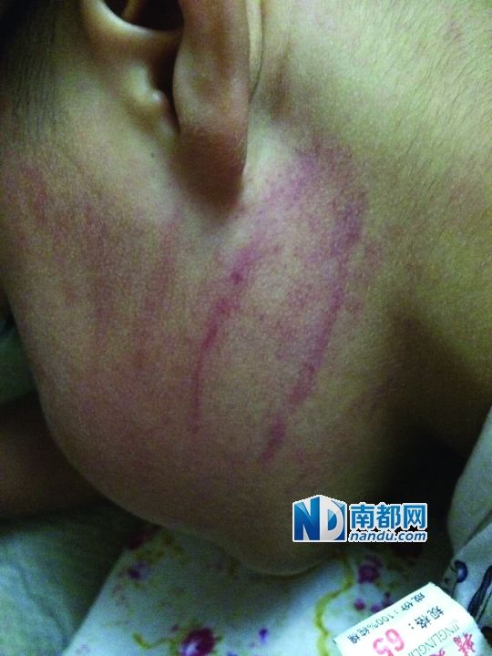 小逸臉上淤痕清晰可見(jiàn)。