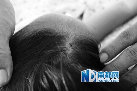 女童頭上被扎的針孔（圓圈處）。賈先生說，被扎不到三秒鐘，女兒就昏了。