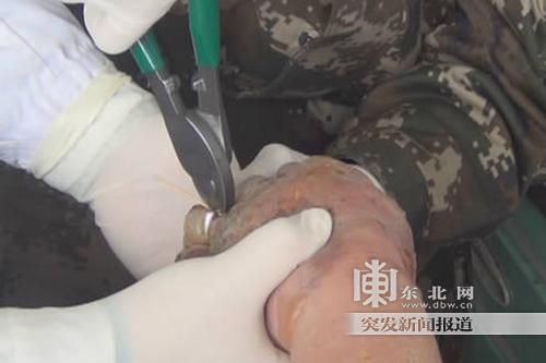 正在拆除戒指。