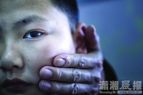 1月13日，小玨的父親心疼地摸著兒子的臉。