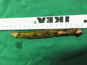 插入男子腦內(nèi)的樹枝。