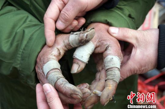 圖為由于常年拾荒，老人雙手布滿傷口。周小云 攝
